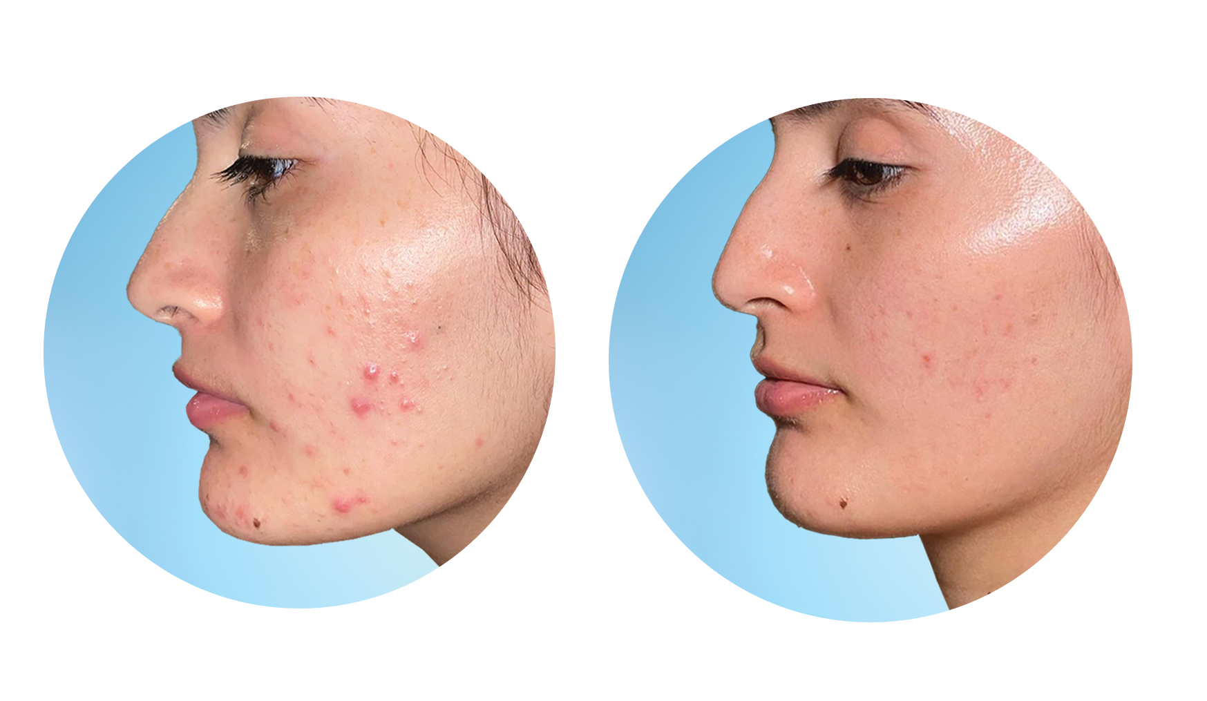 قبل و بعد استفاده از ژل ضدجوش دیفرین