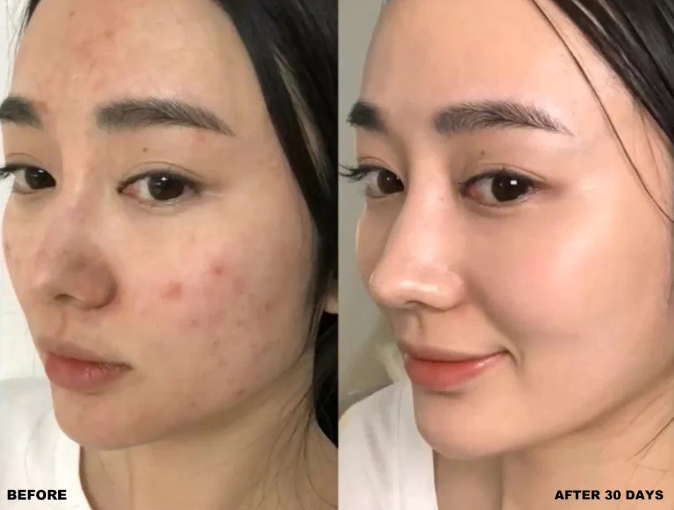 روشنتر شدن و صاف شدن پوست پس از چند هفته استفاده
