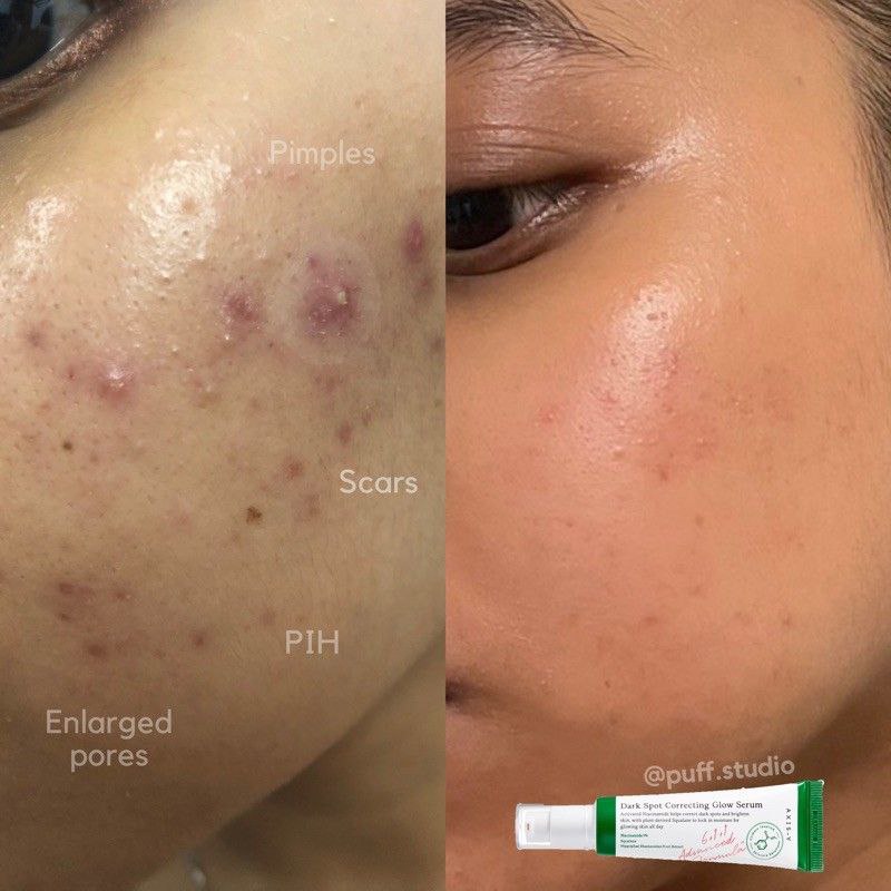 کاهش لکههای تیره و جای جوش با سرم ضد لک Axis-Y